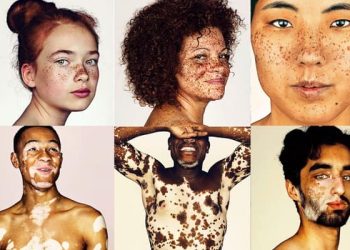 Pessoas com vitiligo