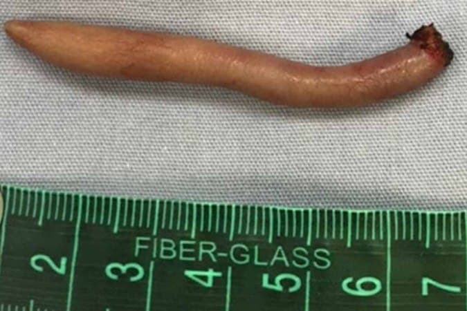 A "cauda" identificada tinha cerca de 6 cm de comprimento - (crédito: Divulgação/Journal of Pediatric Surgery)