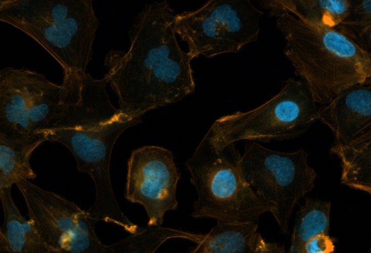 Células de meduloblastoma mantidas em cultura 3D (esferoide tumoral) ou 2D no laboratório do grupo de pesquisa (crédito: Amanda Faria Assoni)