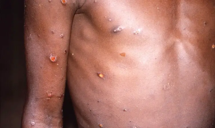 Paciente com lesões na pele provocadas mpox, na República Democrática do Congo - Foto: CDC/BRIAN W.J. MAHY