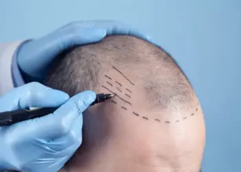 Paciente que sofre de perda de cabelo em consulta com um médico. Médico usando marcador de pele