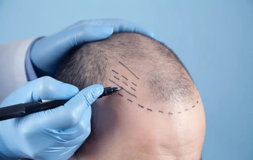 Paciente que sofre de perda de cabelo em consulta com um médico. Médico usando marcador de pele